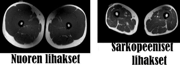Lihaskoon lasku: lihaskato, atrofia, kakeksia Sairaudet, aliravinto, vammat ja onnettomuudet, inaktiivisuus, ikääntyminen Ikääntyessä tervekin menettää ~4-5 % / 10 v luurankolihasmassasta 40