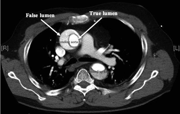 24 Review of literature 25 AscAA and ATAAD can be both revealed by a widened mediastinum on a standard chest X-ray.
