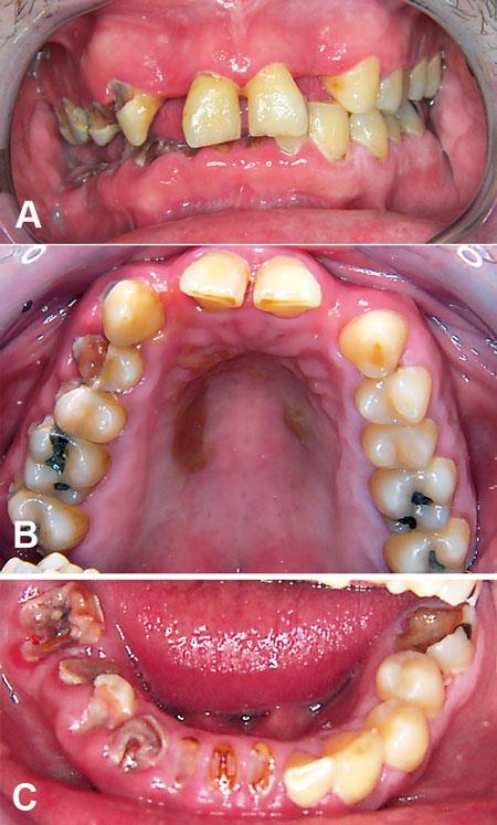 23 7.3 Karies Karieksella tarkoitetaan plakin bakteerien hapontuotannon aiheuttamaa hampaiden kovakudoksen menetystä (19). Syljellä on erittäin suuri merkitys hampaiden karioitumisen kannalta (11).