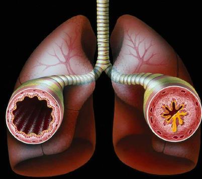 ASTMA ON KROONINEN TULEHDUKSELLINEN SAIRAUS Astma on pitkäaikainen keuhkosairaus, johon kuuluvat keuhkoputkiston limakalvotulehdus (inflammaatio) ja siihen liittyvä keuhkoputkien lisääntynyt