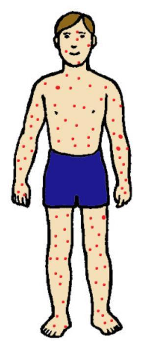 ROKKOTAUDIT: VESIROKKO Vesirokko on herpesviruksiin kuuluva erittäin herkästi tarttuva kuumetauti. Tartunnan voi saada sairastuneen lapsen rakkuloiden tai hengitysteiden välityksellä.
