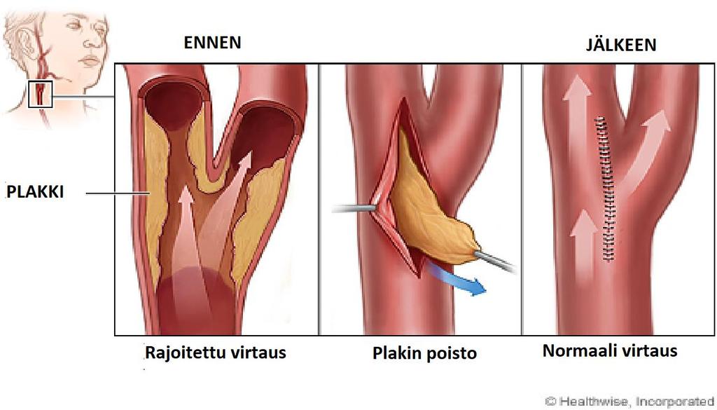 Kuva 1. (Muokattu viite, joka otettu sivulta: https://myhealth.alberta.ca/health/pages/conditions.aspx?hwid=abk6997.) 22 2.