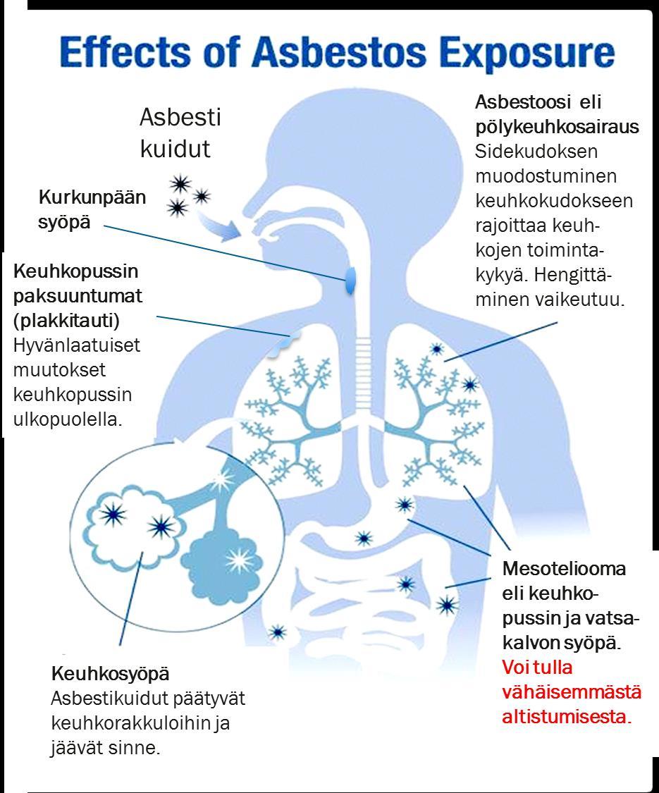Miksi asbestille altistuminen on vaarallista? Asbestikuidut erittäin vaarallisia, eivät poistu elimistöstä. Suurin osa keuhkoihin joutuvista kuiduista jää sinne. Eivät ärsytä altistumisen aikana.