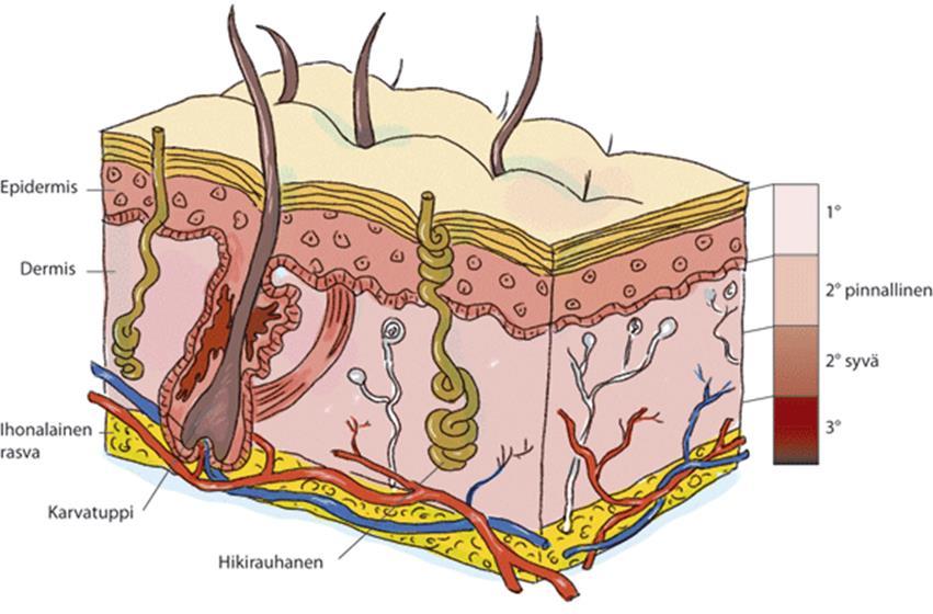 3 3 PALOVAMMAN PATOFYSIOLOGIA JA ANATOMIA Palovammalla tarkoitetaan paikallista kudosvauriota, joka voi aiheutua lämmöstä (esimerkiksi kuuma vesi tai kiuas), liekistä, leimahtavasta nesteestä,