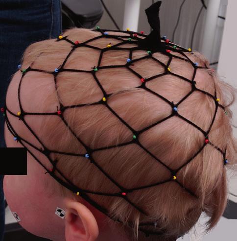 34 Materials and methods Figure 4. A two-year-old child in study IV wearing the pearl mesh.