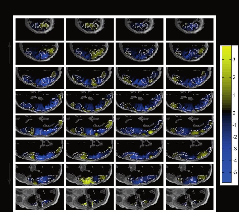 Results 41 Figure 7. Averaged HbT responses to emotional speech over the 21 subjects within the time window [2s, 18s] from stimulus onset in the left hemisphere.