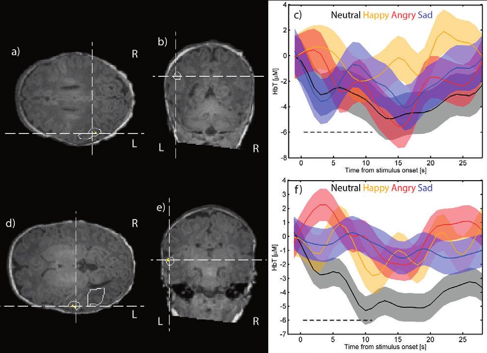 42 Results Figure 8. Location of clusters showing a negative HbT response to emotional speech stimuli, with voxels that satisfy p < 0.001 marked in yellow and p = 0.