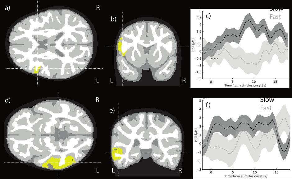 Results 47 touch would be processed in more socio-emotional brain regions of children than non-affective touch.