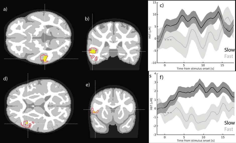 48 Results HbT: 2.6; Bonferroni corrected p= 5 10-5 ; Fig. 11). No significant clusters were found for slow vs. fast or fast vs. baseline or fast vs slow.