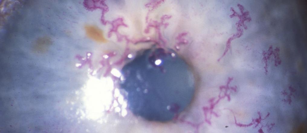 HSV epiteelikeratiitin hoito Epiteelileesion kuorinta (PCR) Asikloviiri (ACV)/ Gansikloviiri (GCV)