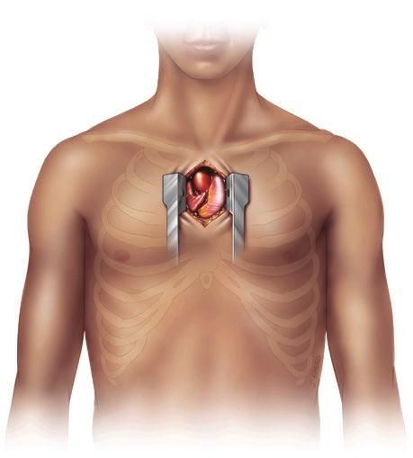 Miten aorttaläpän ahtaumaa voi hoitaa? Kardiologini mukaan vaikeaa aorttaläpän ahtaumaa voi hoitaa kahdella eri tavalla.