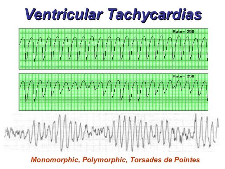 12 5 FOUR CARDIAC ARREST RHYTHMS 5.