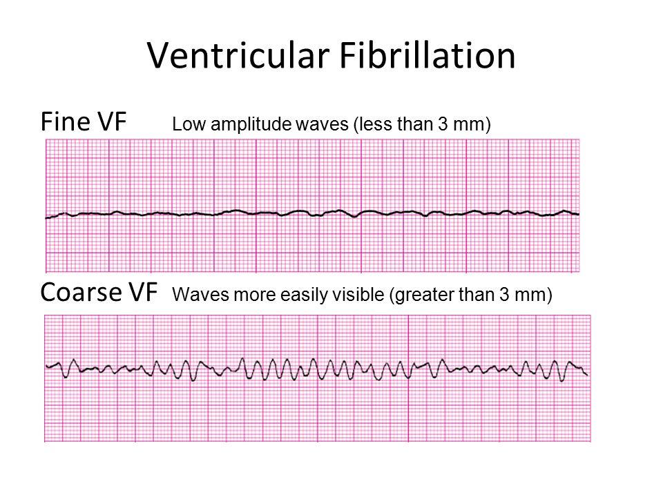 15 2016, 217-218) Fine ventricular fibrillation (Figure 6) has smaller waves, which is follows coarse ventricular fibrillation as the heart muscle depletes its metabolic stores the probability for