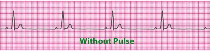 17 5.3 Pulseless Electrical Activity (PEA) Pulseless electrical activity (PEA) is in a condition which the ECG shows activity that should produce a pulse, but no pulse is detectable in the patient.