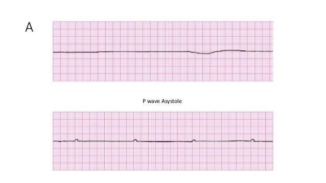 20 Asystole is represented on the ECG tracing looks like a nearly flatline or wave line (Figure 8), except for changes caused by chest compressions during CPR (Coviello 2016, 159).