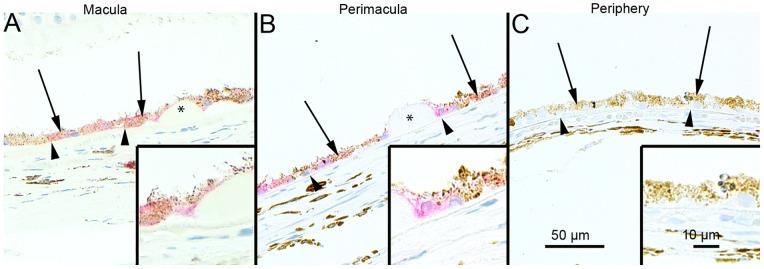 p62 ja AMD The SQSTM1/p62 staining in the foveomacular areas of the AMD patients was more extensive compared to the