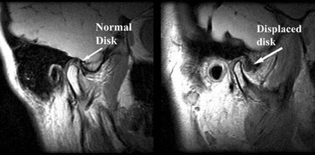 16 Kuva 9. Leukanivelen välilevyn kuvantaminen magneettikuvauksella. Vasemmalla normaali välilevy, oikealla dislokoitunut. (Tore ym. 2009) 3.