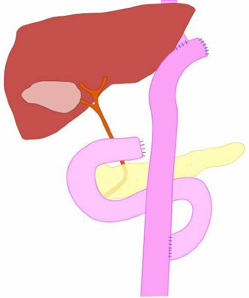Kuva 5 Roux-en-Y rekonstruktio. (Simple diagram of total gastrectomy with Roux-en-Y 2006. Julkaistu luvalla: commons.wikimedia.org/wiki/file:total_gastrectomy_with_roux-en-y.
