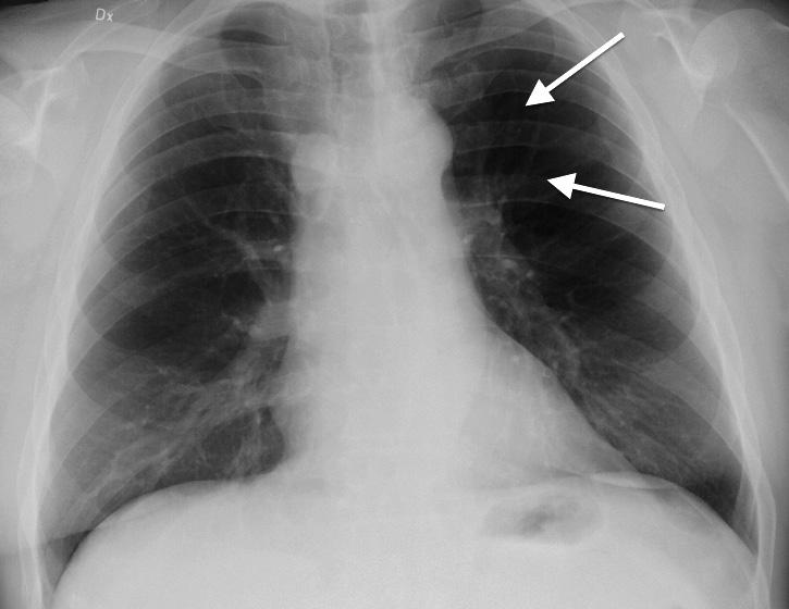 Radiologisen tutkimuksen perusteet syntyy röntgenputken tuottaessa röntgensäteilyä, joka ohjataan kuvattavan kohteen lävitse kuvalevylle.