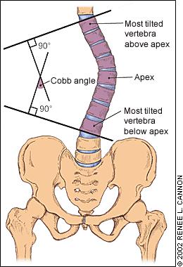 8 Selkärangan röntgenkuvauksen katsotaan olevan tarpeellinen, kun skoliometrin lukema on vähintään 6 astetta tai, jos kliinisen tutkimuksen perusteella epäillään selkärangan epätasapainoa, käyryyttä