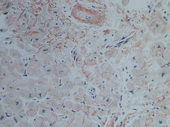 Kappaketjut värjäytyvät mustana. Kokonaisuudessaan histologinen löydös sopii AL-amyloidoosiin. (4, 19).