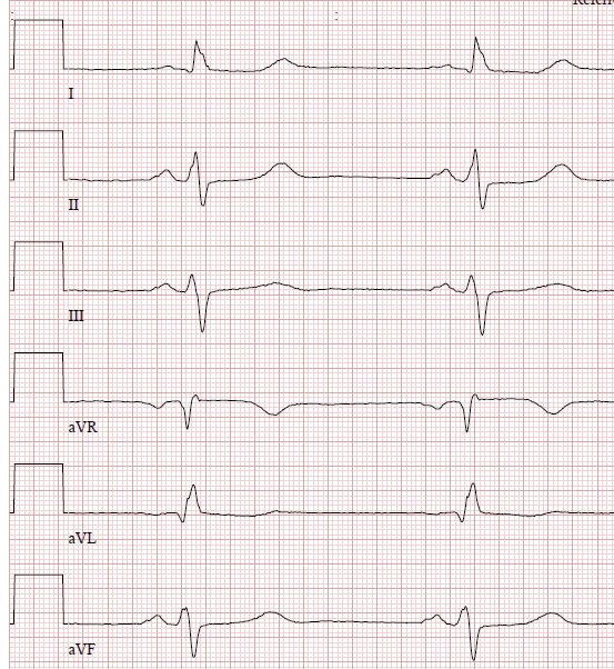 A B Kuva 1. 54-vuotiaan naisen EKG.