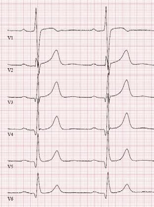 Potilaalla oli alfatropomyosiinigeenin mutaation aiheuttama HCM. A B Kuva 2. HCM-potilaan EKG.