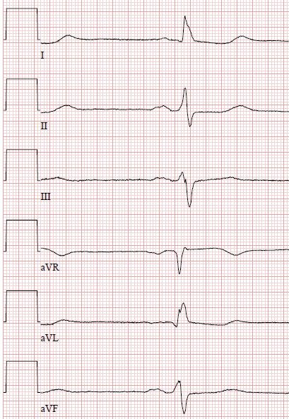 (A): Todetaan rajapintainen LVH ja hiukan korostuneet Q-aallot kytkennöissä V4 V6 (syvyys noin 3