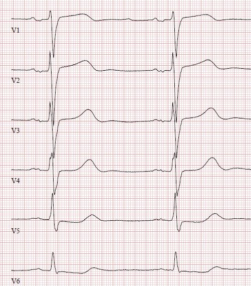 Lisäksi R-aalto ei kasva johdonmukaisesti kytkennästä V1 kytkentöihin V2 ja V3 (RV1>RV2, septal