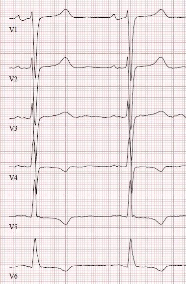 Todetaan LVH Sokolow-Lyon kriteerien mukaan ja lievät ST-laskut kytkennöissä V5 V6. Raajakytkennöissä on matalat T-aallot.