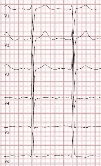 kohonneesta vasemman kammion täyttöpaineesta. Kuva 3 näyttää EKG-muutosten progressiota kymmenen vuoden aikavälillä DCM-potilaalla.