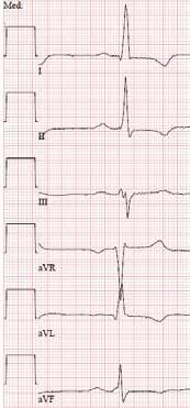 Kuva 4. Fabryn tautia sairastavan naisen EKG. Raajakytkennät ylhäällä ja rintakytkennät alhaalla.