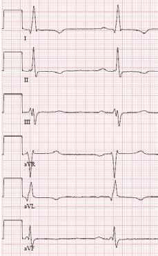 Todetaan LVH (SV1 + RV5 = 41 mm) ja kuormitusmuutokset (lateraaliset alaspäin viettävät