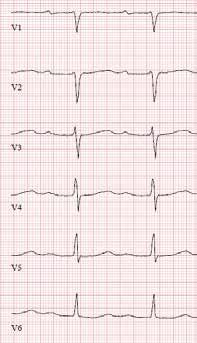 Kuva 5 esittää sydänamyloidoosia sairastavan potilaan EKG-sarjan. Kuva 5.