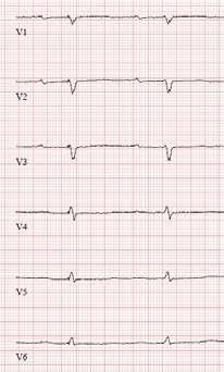 Lievästi pidentynyttä PQ-aikaa lukuun ottamatta EKG on normaali.