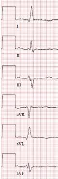 Keskimmäinen EKG on rekisteröity 7 vuotta myöhemmin.