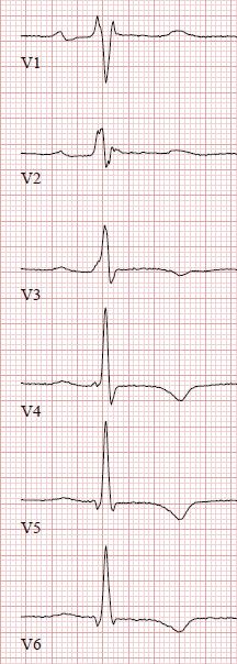 Oikeanpuoleinen EKG on rekisteröity 14 vuotta ensimmäisen EKG:n jälkeen.