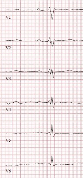 QRS-solmuilua on nyt useammassa rintakytkennässä, selvemmin V2 V3 (septal remodeling).