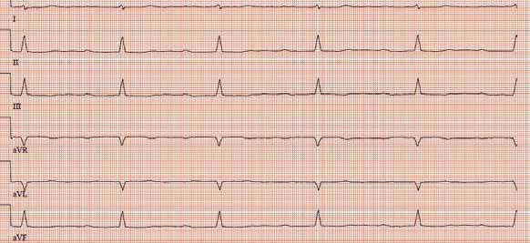 septal remodeling, patologinen löydös septaalisissa EKGkytkennöissä V1 V3 (16) (kuva 1).