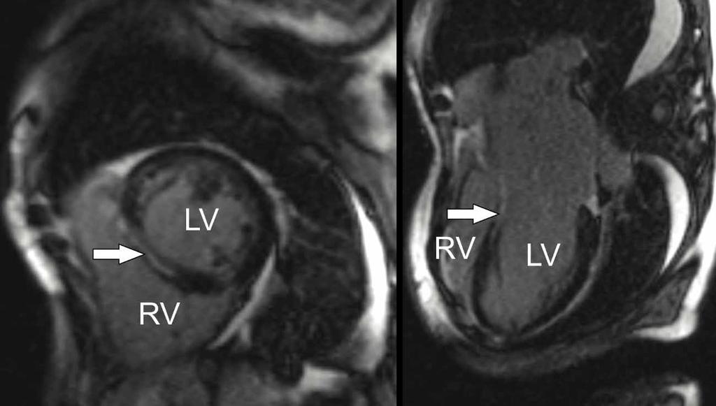 Kuva 2. Septaalista myöhäistehostumaa (LGE, merkitty nuolilla) myöhäiskeski-ikäisen lamiinikardiomyopatiapotilaan sydämen MRI-kuvassa (LV, vasen kammio; RV, oikea kammio).