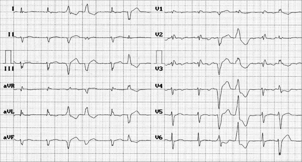 dysfunction associated, thromboembolic, and the mixed form.