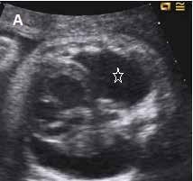 TAULUKKO 1. Lasten kardiomyopatioiden syitä DCM HCM RCM LVNC Geneettinen/familiaalinen + + + + Infektiot 10 20 % entero-, adeno-, herpesvirukset, parvovirus B19, Borrelia burgdorferi -?