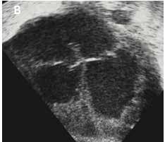 skleroderma, endokardiaalinen fibroosi, sarkoidoosi Kawasakin tauti Syndroomat Barthin sdr Noonan, Costello, LEOPARD, Beckwith-Wiedemann, Friedreichin ataksia Takyarytmiat + Lääkkeet + + A B C Kuva 1.