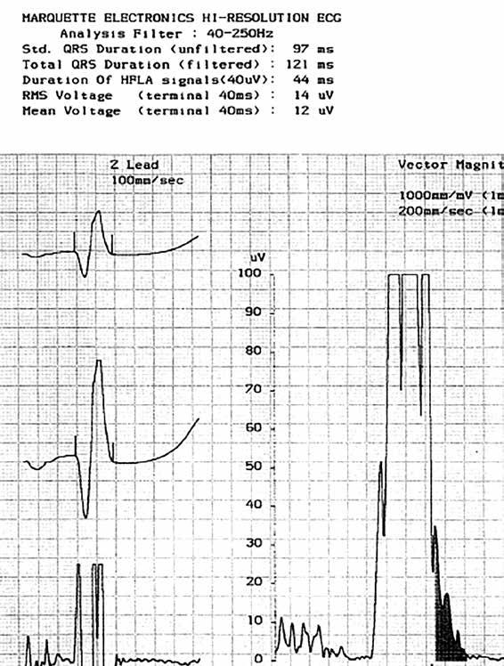 Määritelmän mukaan epsilon-aalto on toistettava, matalaamplitudinen signaali QRS-kompleksin lopun ja T-aallon alun välissä, kytkennöissä V1-V3.