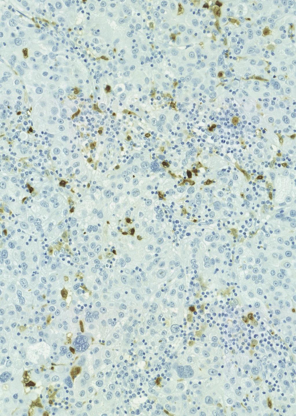 IMMUNOLOGY OF BLADDER CANCER Minna