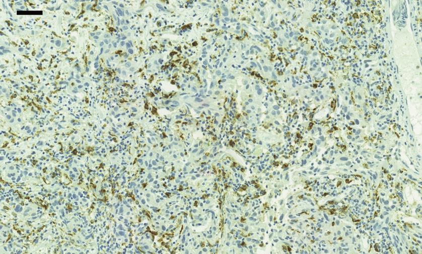 4 Markers 4.1 CD68 CD68 (also known as gp110 or macrosialin) is a 110 Kd transmembrane lysosomal glycoprotein expressed on tissue macrophages and blood monocytes.