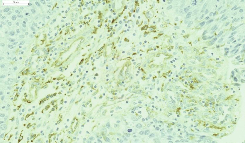 Review of literature However, it associates with increased tumor metastasis and proliferation in glioblastoma.356, 362 Figure 6. CLEVER-1 (antibody 2-7) staining in bladder cancer tissue.