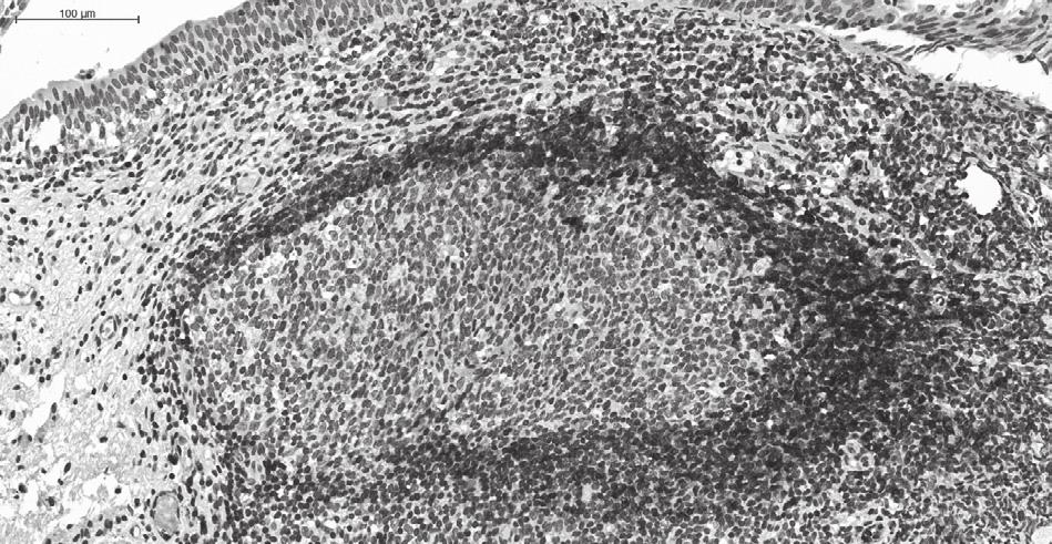 tissue types need to be accomplished. a b c Figure 8. CD73 staining in bladder cancer tissue: a.