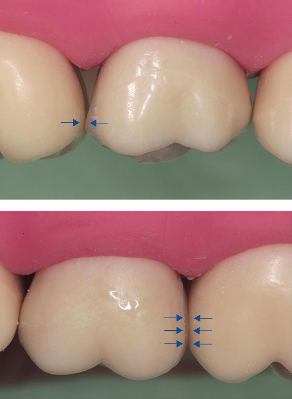 tavat parodontiitille [83]. Paikkojen ja kruunujen muotoilun pitää noudattaa myös ienrajassa hampaiden luonnollista muotoa [83].