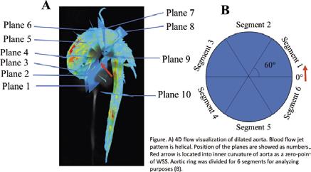 13.05 13.20 S. Petteri Kauhanen (BM) Kuopio University Hospital, Clinical Radiology Displaced aortic flow and increased circumferential wall shear stress associate to ascending aortic dilatation.